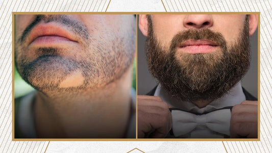 Beard Transplant FAQ: Answering the Most Common Questions - Daily Grind